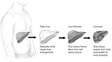 fatty liver diseas